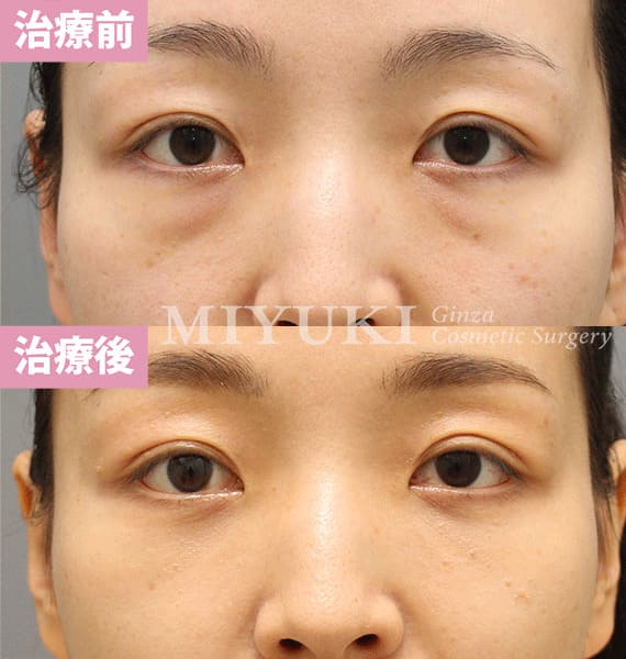 モニター症例№365（33歳 女性）脱脂コンデンスリポ