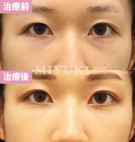 モニター症例№368（28歳 女性）脱脂コンデンスリポ