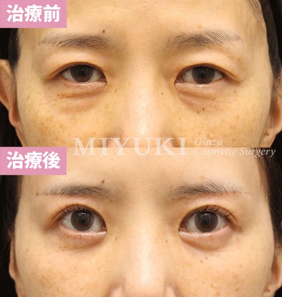 モニター症例№369（51歳 女性）脱脂コンデンスリポ