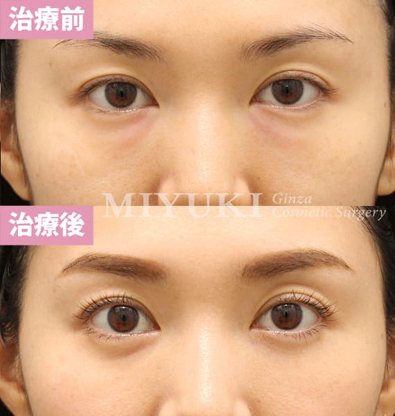 モニター症例№370（34歳 女性）脱脂コンデンスリポ