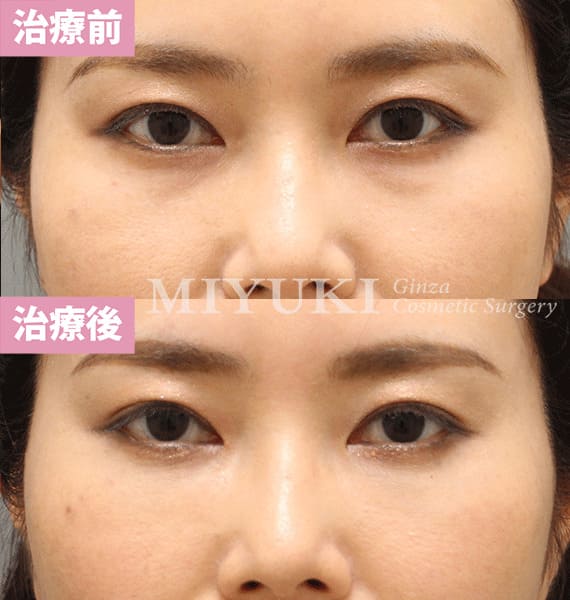 モニター症例№371（42歳 女性）脱脂コンデンスリポ