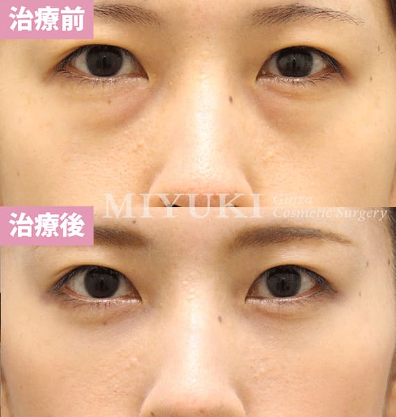 モニター症例№372（35歳 女性）脱脂コンデンスリポ