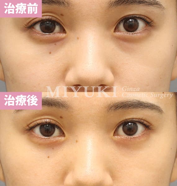 モニター症例№373（24歳 女性）脱脂コンデンスリポ