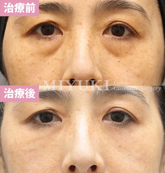 モニター症例№374（60歳 女性）脱脂コンデンスリポ