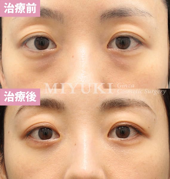 モニター症例№375（38歳 女性）脱脂コンデンスリポ