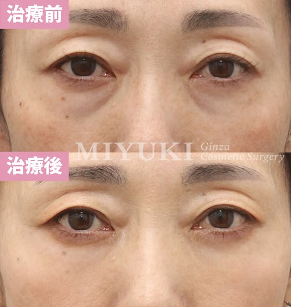 モニター症例№376（53歳 女性）脱脂コンデンスリポ