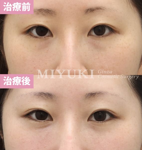 モニター症例№377（28歳 女性）脱脂コンデンスリポ