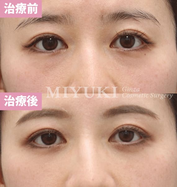 モニター症例№378（31歳 女性）脱脂コンデンスリポ