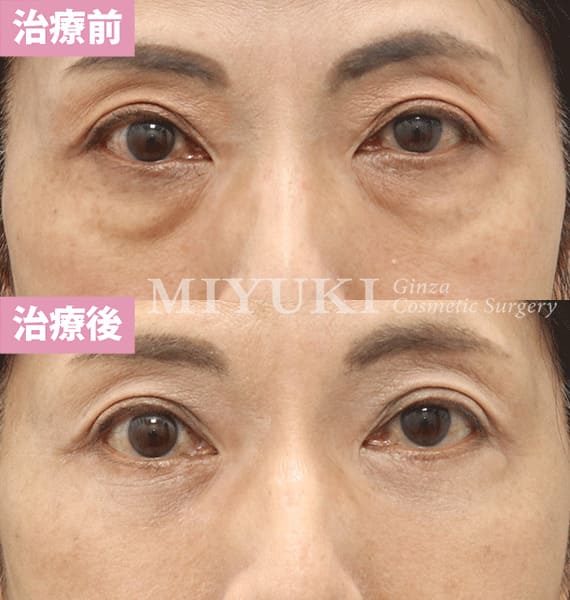 モニター症例№379（57歳 女性）脱脂コンデンスリポ