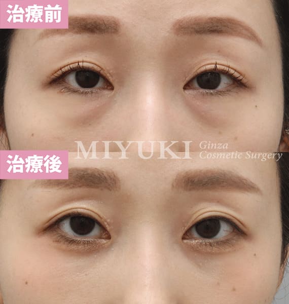 モニター症例№380（37歳 女性）脱脂コンデンスリポ