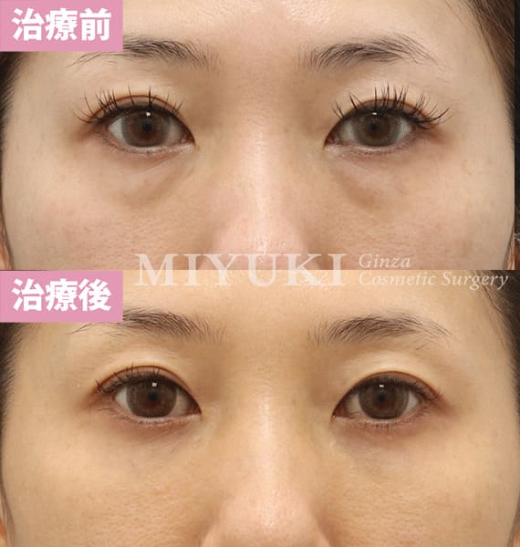 モニター症例№381（38歳 女性）脱脂コンデンスリポ