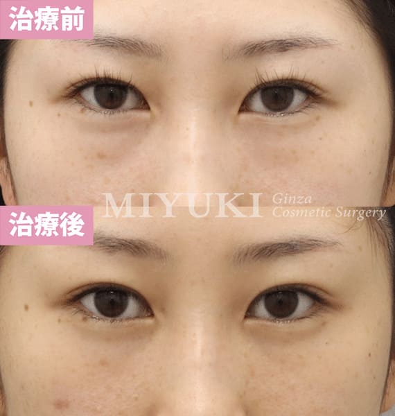 モニター症例№382（24歳 女性）脱脂コンデンスリポ