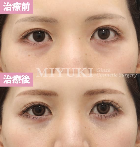 モニター症例№386（28歳 女性）経結膜脱脂