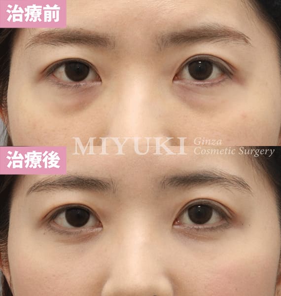 モニター症例№387（33歳 女性）脱脂コンデンスリポ