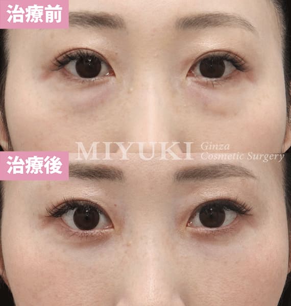 モニター症例№389（32歳 女性）脱脂コンデンスリポ