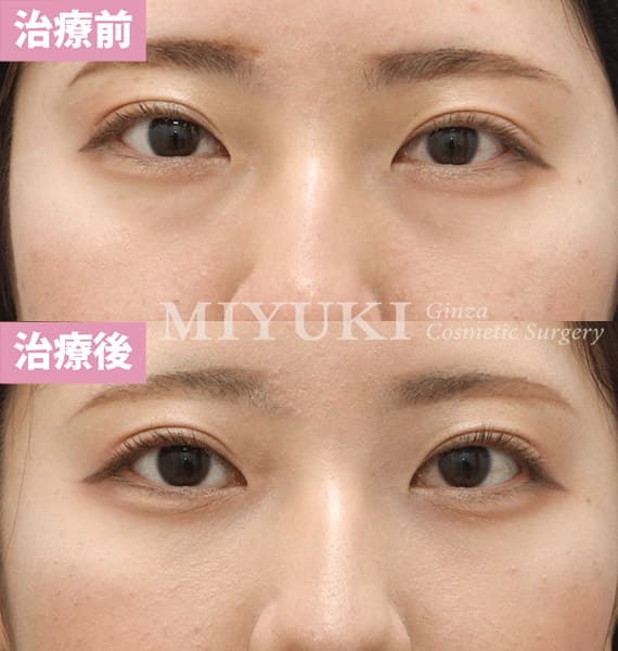 モニター症例№390（20歳 女性）脱脂コンデンスリポ