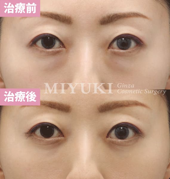 モニター症例№391（44歳 女性）脱脂コンデンスリポ