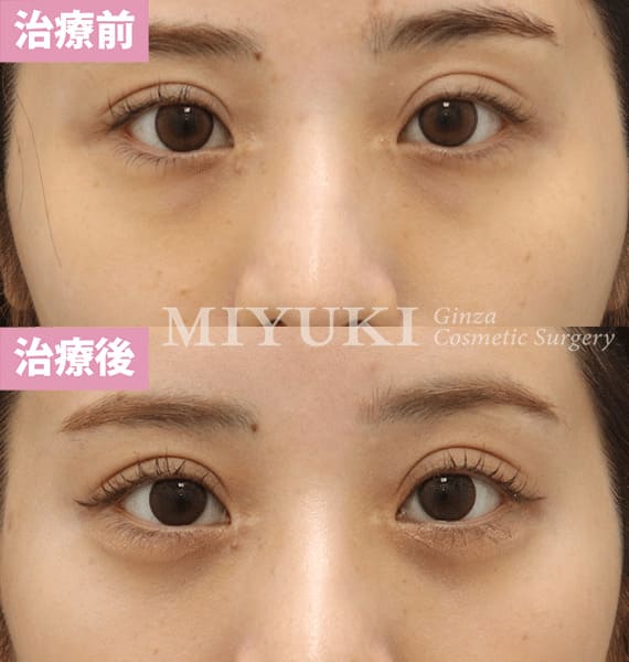 モニター症例№392（27歳 女性）経結膜脱脂