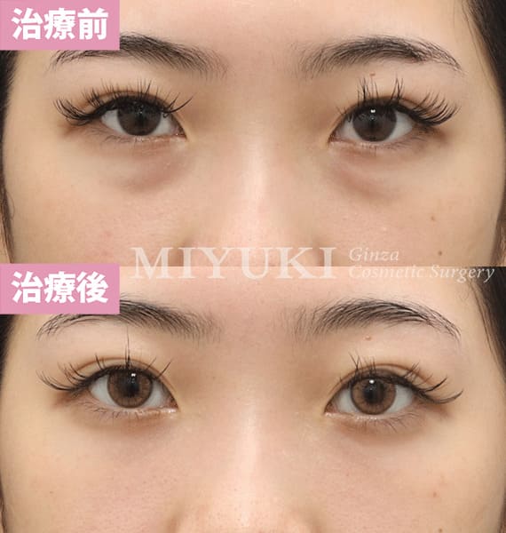 モニター症例№393（20歳 女性）脱脂コンデンスリポ