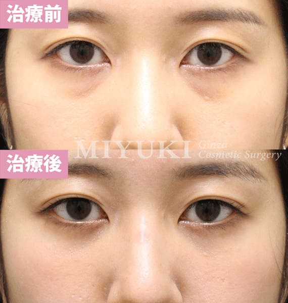 モニター症例№394（22歳 女性）脱脂コンデンスリポ