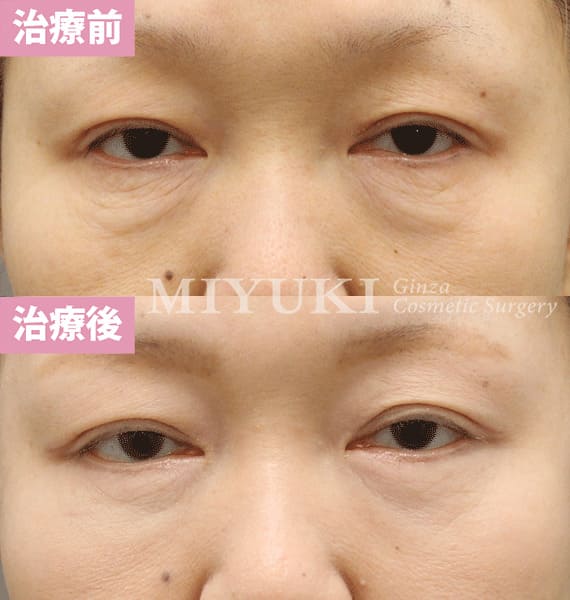 モニター症例№395（53歳 女性）下まぶた切開ハムラ法