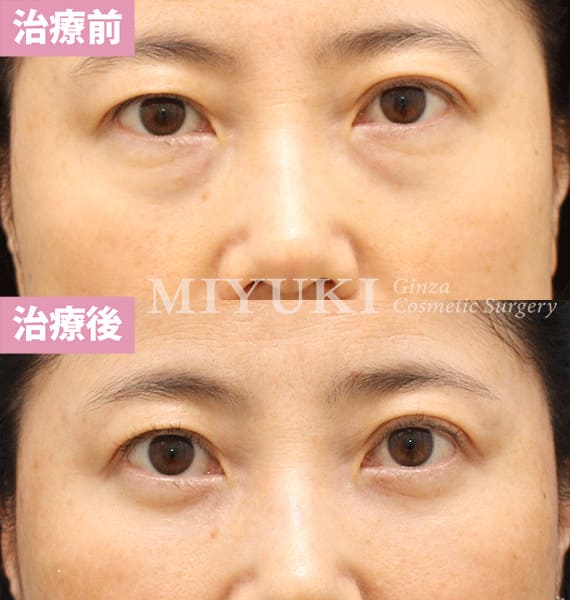 モニター症例№397（48歳 女性）脱脂コンデンスリポ