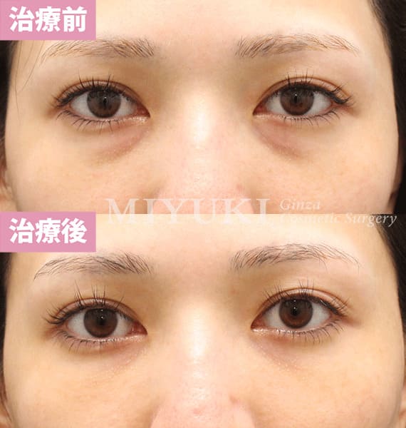 モニター症例№398（27歳 女性）脱脂コンデンスリポ