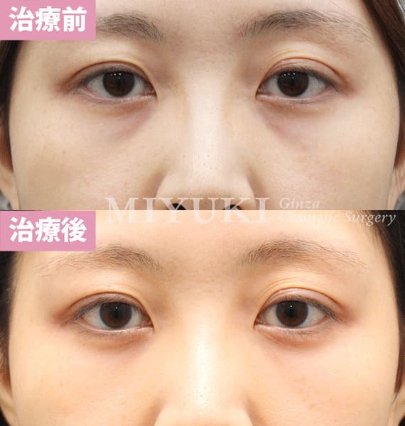 モニター症例№399（33歳 女性）脱脂コンデンスリポ