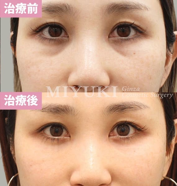 モニター症例№402（34歳 女性）脱脂コンデンスリポ