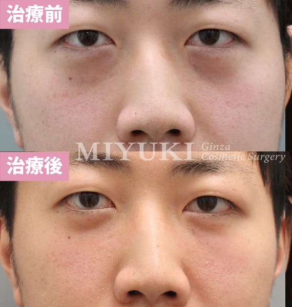 モニター症例№403（31歳 男性）脱脂コンデンスリポ