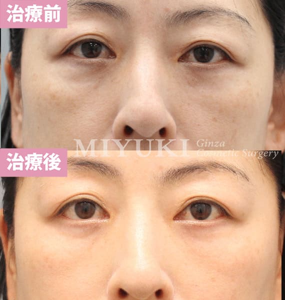 モニター症例№404（48歳 女性）脱脂コンデンスリポ