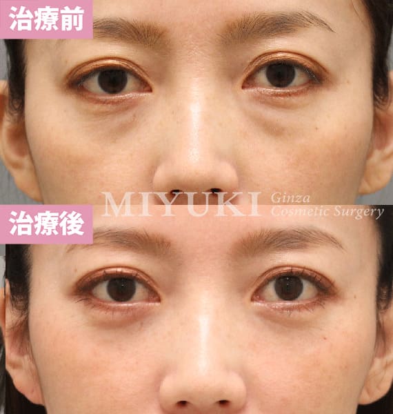 モニター症例№405（41歳 女性）脱脂コンデンスリポ