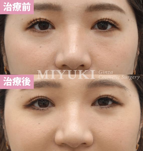 モニター症例№406（34歳 女性）経結膜脱脂