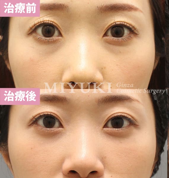 モニター症例№407（34歳 女性）脱脂コンデンスリポ