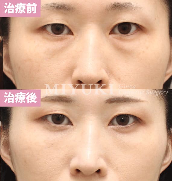 モニター症例№408（34歳 女性）脱脂コンデンスリポ