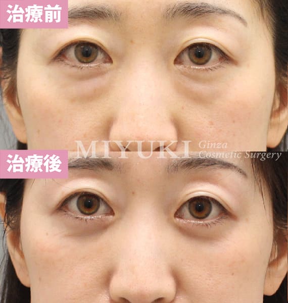 モニター症例№410（41歳 女性）脱脂コンデンスリポ