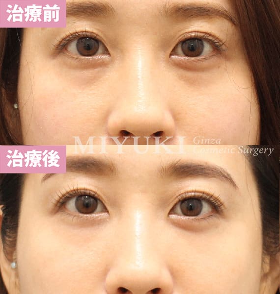 モニター症例№411（35歳 女性）脱脂コンデンスリポ