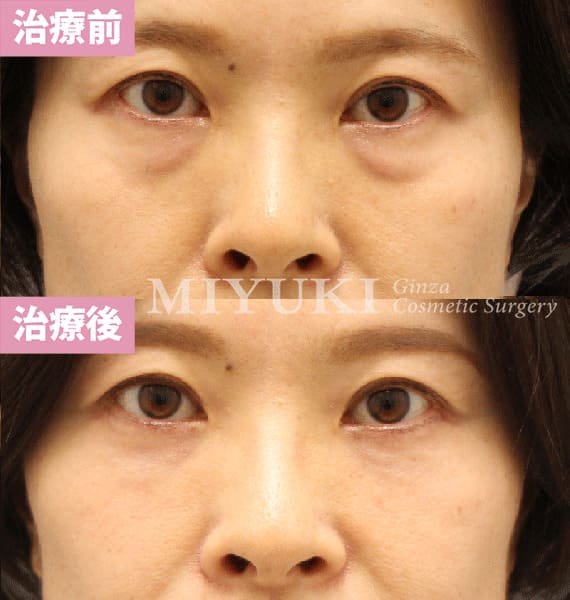 モニター症例№412（47歳 女性）脱脂コンデンスリポ