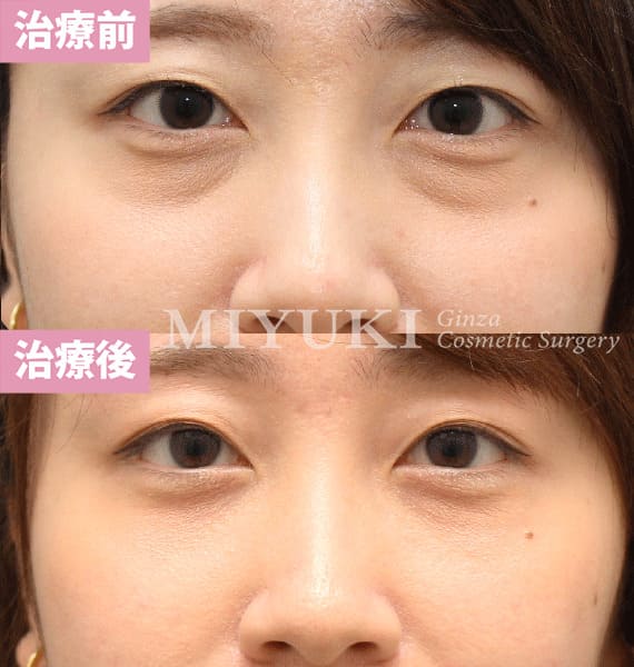 モニター症例№413（28歳 女性）脱脂コンデンスリポ