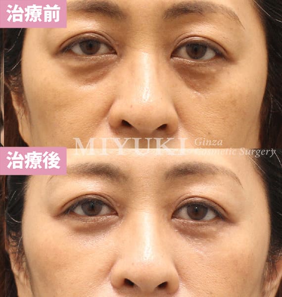 モニター症例№414（42歳 女性）脱脂コンデンスリポ