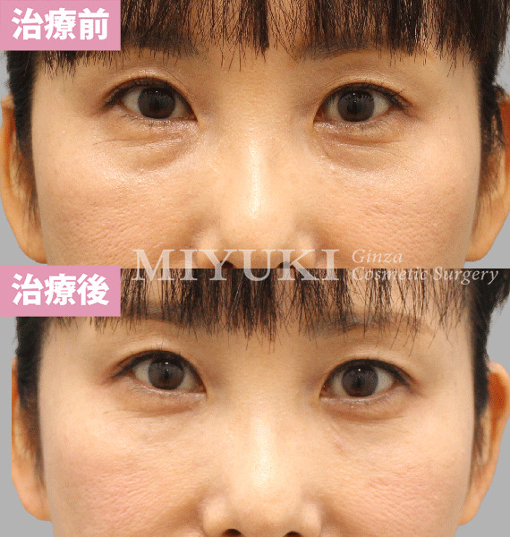 モニター症例№415（50歳 女性）脱脂コンデンスリポ