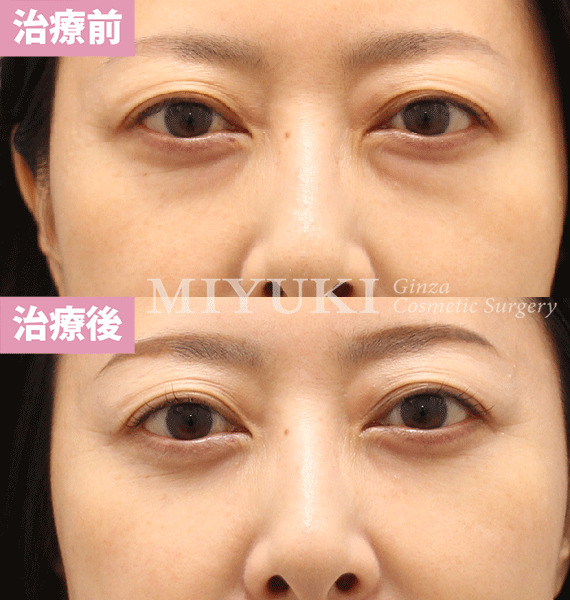 モニター症例№416（49歳 女性）脱脂コンデンスリポ