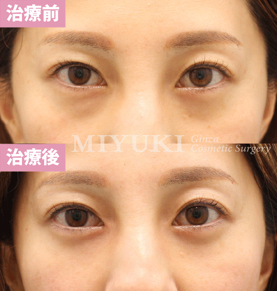 モニター症例№418（35歳 女性）脱脂コンデンスリポ