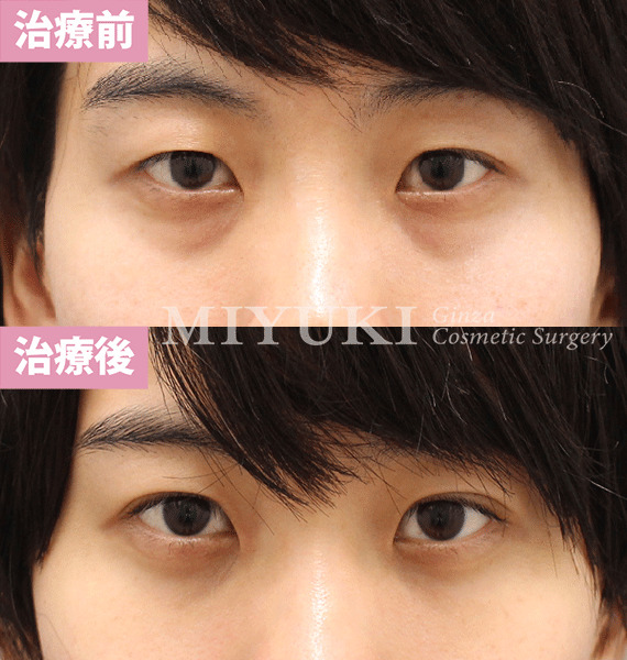 モニター症例№419（26歳 男性）脱脂コンデンスリポ