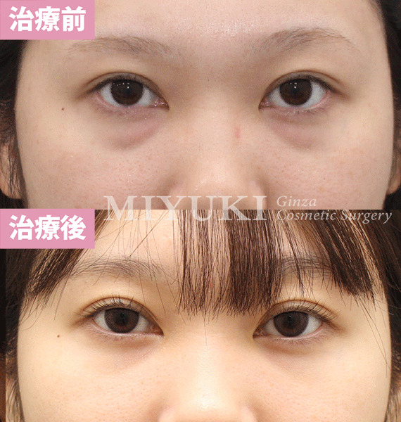 モニター症例№421（24歳 女性）脱脂コンデンスリポ