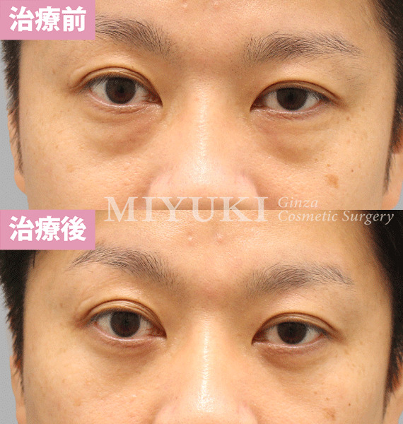 モニター症例№422（44歳 男性）脱脂コンデンスリポ