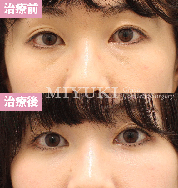 モニター症例№423（27歳 女性）脱脂コンデンスリポ