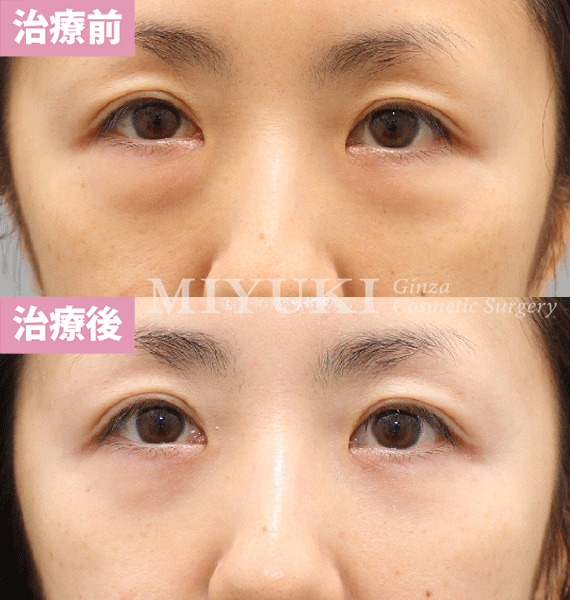 モニター症例№424（38歳 女性）脱脂コンデンスリポ