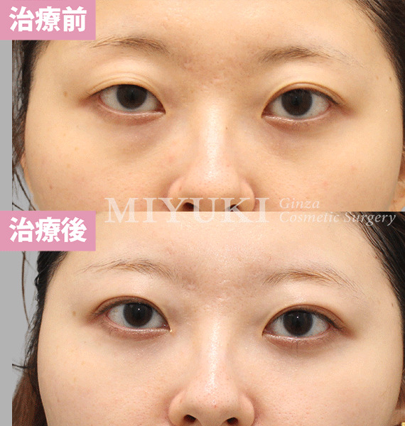 モニター症例№425（26歳 女性）脱脂コンデンスリポ