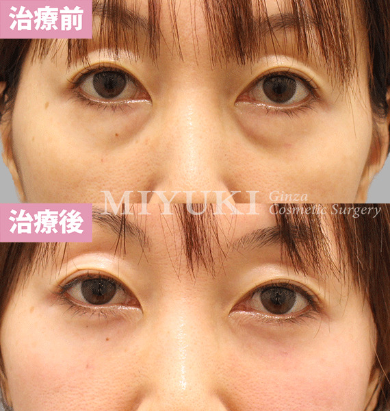 モニター症例№426（43歳 女性）脱脂コンデンスリポ